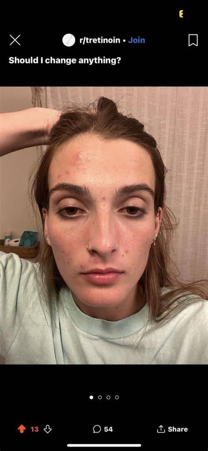 IPL/BBL ruined my skin 6 months later and looking worse than ever